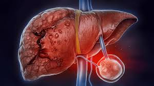 Karaciğer Kanseri - Tıbbi Görsel